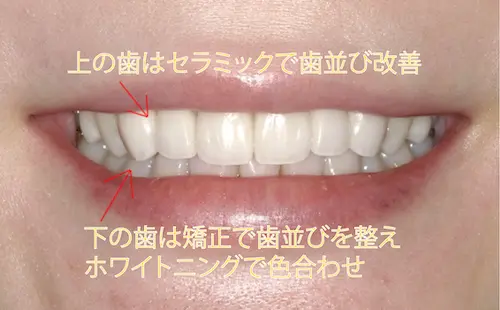 オールセラミック治療後｜東京都港区青山