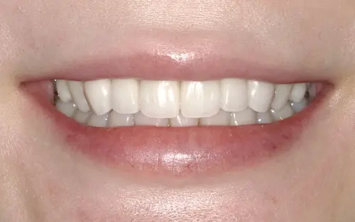 オールセラミックafter｜東京都港区青山