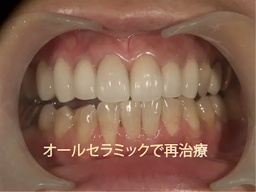 黒くなった差し歯(アフター)