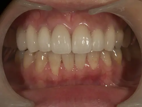 東京都港区青山の歯医者 セラミック矯正の症例 アフター