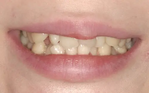 セラミック矯正 ビフォー | 東京・港区