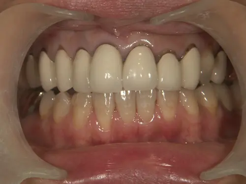 東京都港区青山の歯医者 セラミック矯正の症例 ビフォー