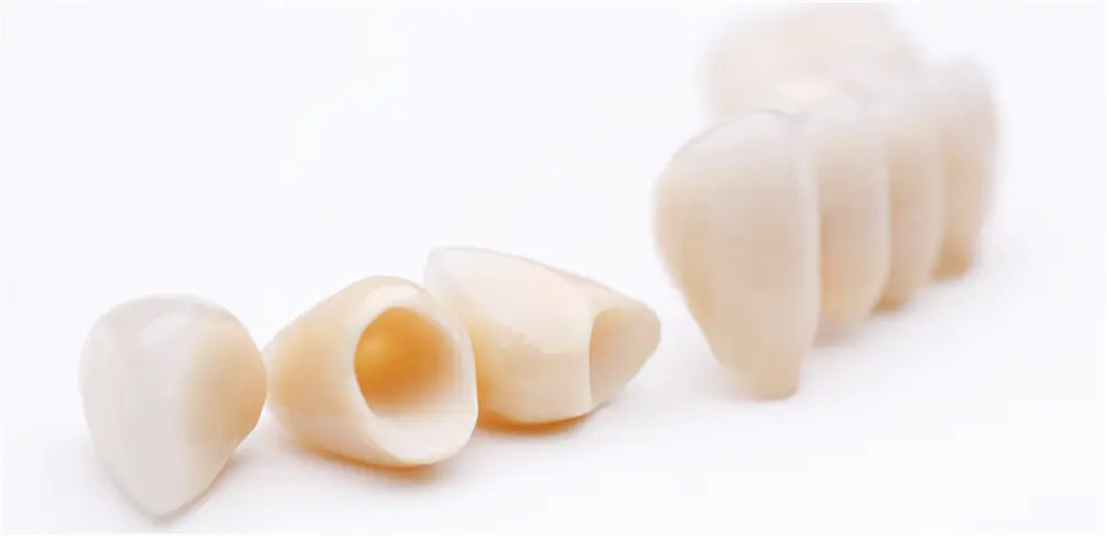 セラミック矯正で望み通りの美しい歯並び