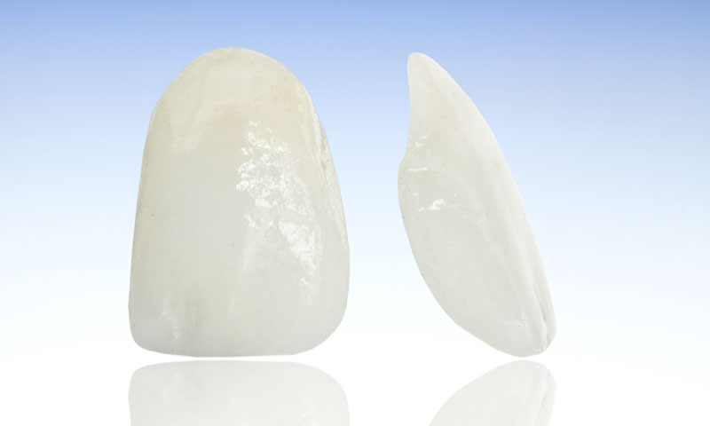 東京都港区青山の歯医者 ラミネートべニア