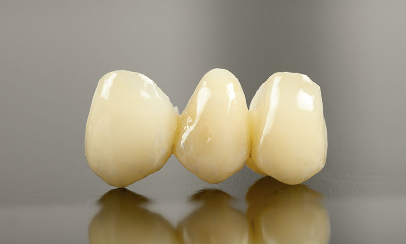東京都港区青山の歯医者 プレスセラミックについて