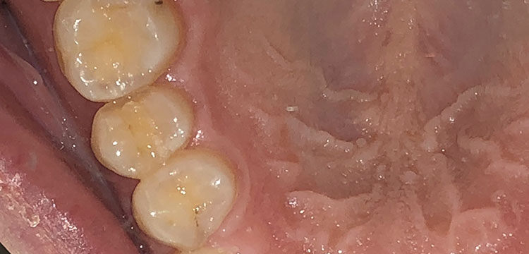 東京都港区青山の歯医者 プレスセラミックインレー