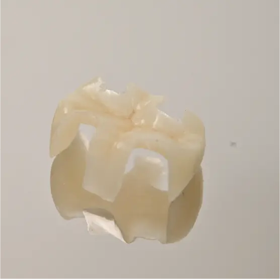 東京都港区青山の歯医者 ジルコニアインレー|東京・港区