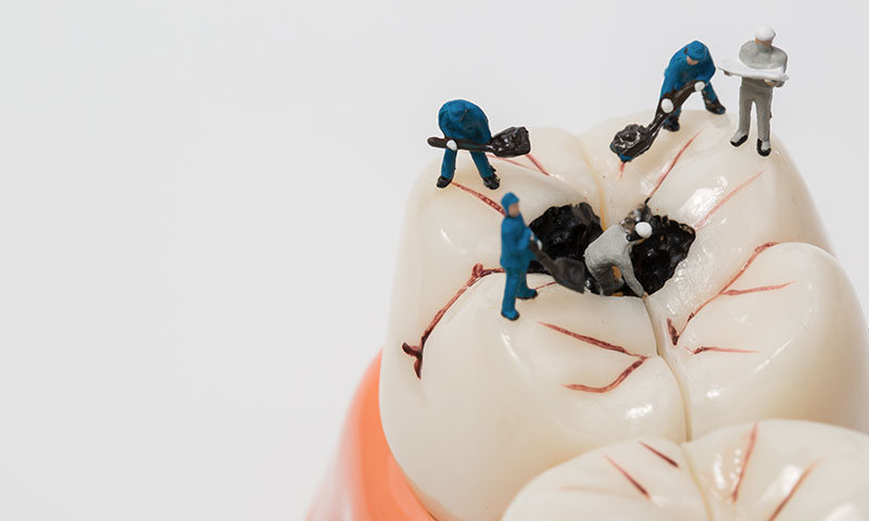 東京都港区青山の歯医者 虫歯治療について