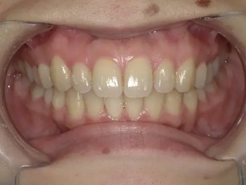 部分矯正 アフター｜東京・港区の歯医者