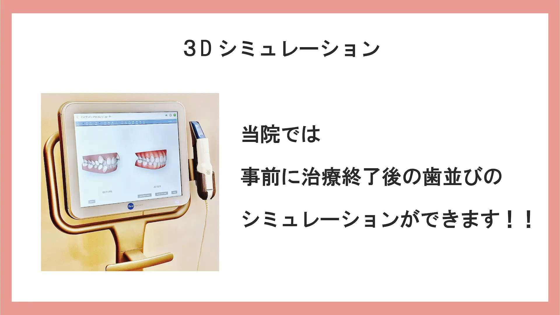 港区青山のマウスピース矯正、歯の３Dシミュレーションでビフォーアフターの確認