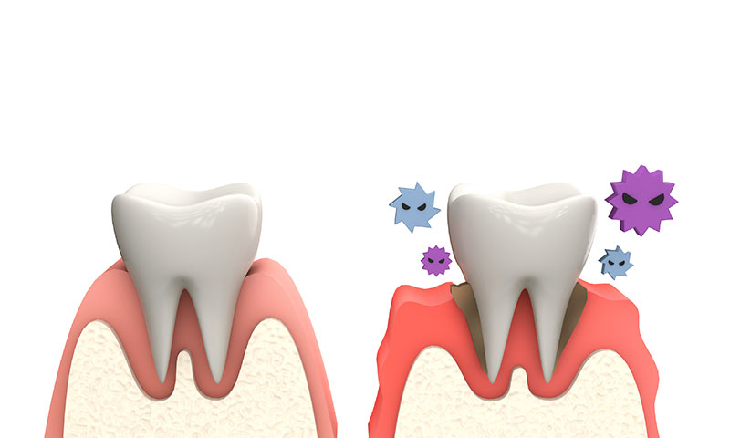東京都港区青山の歯医者 歯周病の原因