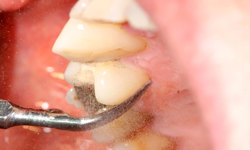 東京都港区青山の歯医者 無痛治療について