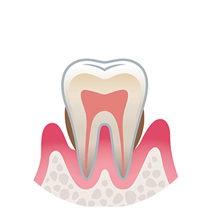 東京都港区青山の歯医者 歯周炎