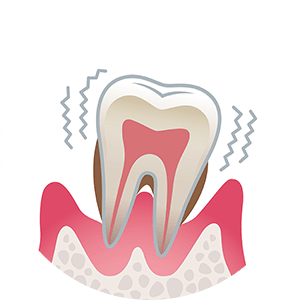 東京都港区青山の歯医者 重度歯周炎